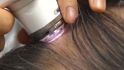 스트레스성 탈모 늘어...운동·규칙적인 수면 도움 / YTN