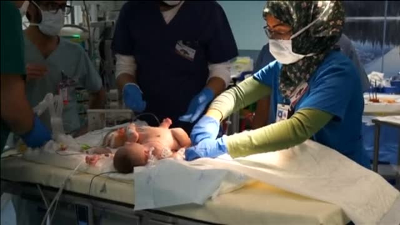Sobrevive una de las siamesas palestinas separa...