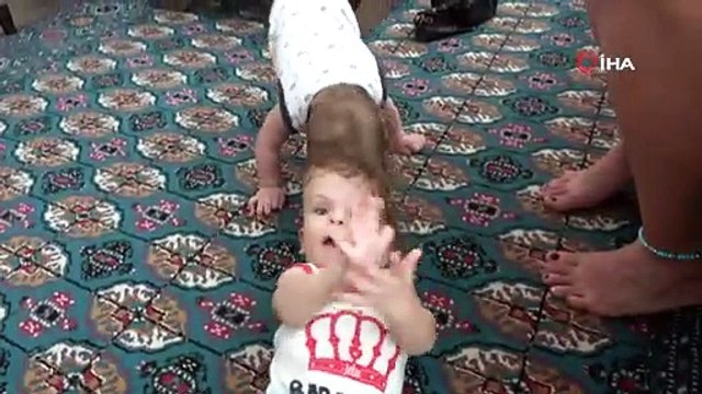Kafadan yapışık siyam ikizleri 1 yaşında