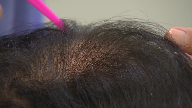 '탈모 과장 광고' 수두룩...탈모 치료에도 골든타임 있나? / YTN