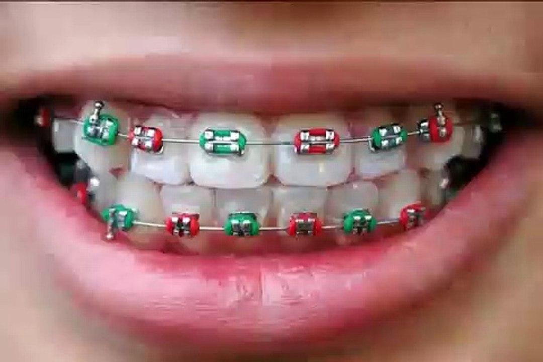 Wie werden Zahn Brackets am Zahn befestigt
