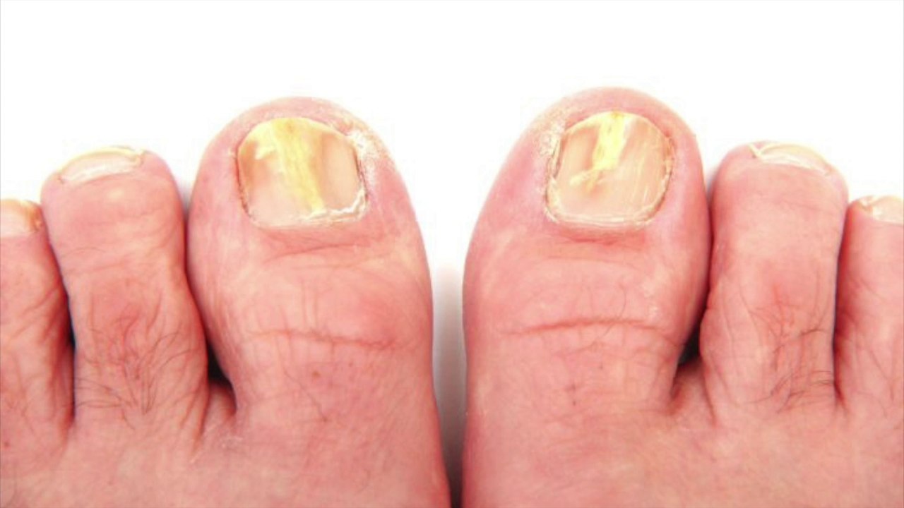 Why is toenail fungus difficult to treat?