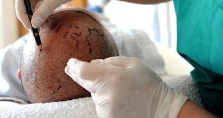 Türkiye'de saç ekim ekonomisi 1 milyar doları geçti