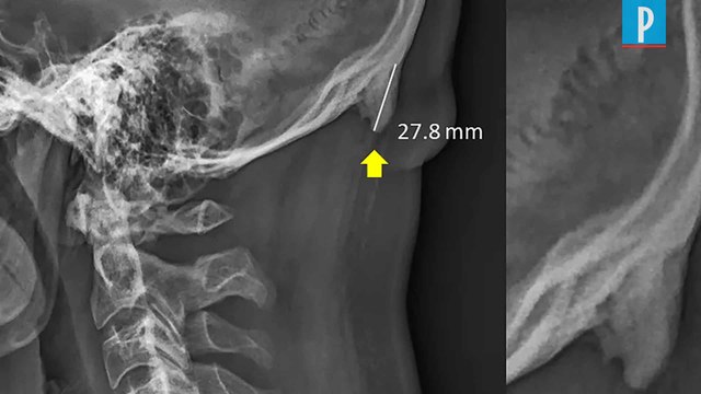 Des cornes sur le crâne des jeunes adultes accros au smartphone ?