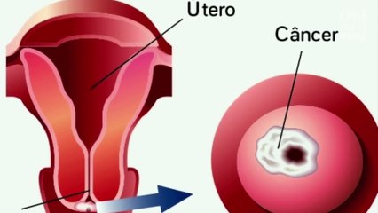 7 sinais que podem indicar câncer no colo do útero