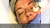 Microneedling in the Denver Region