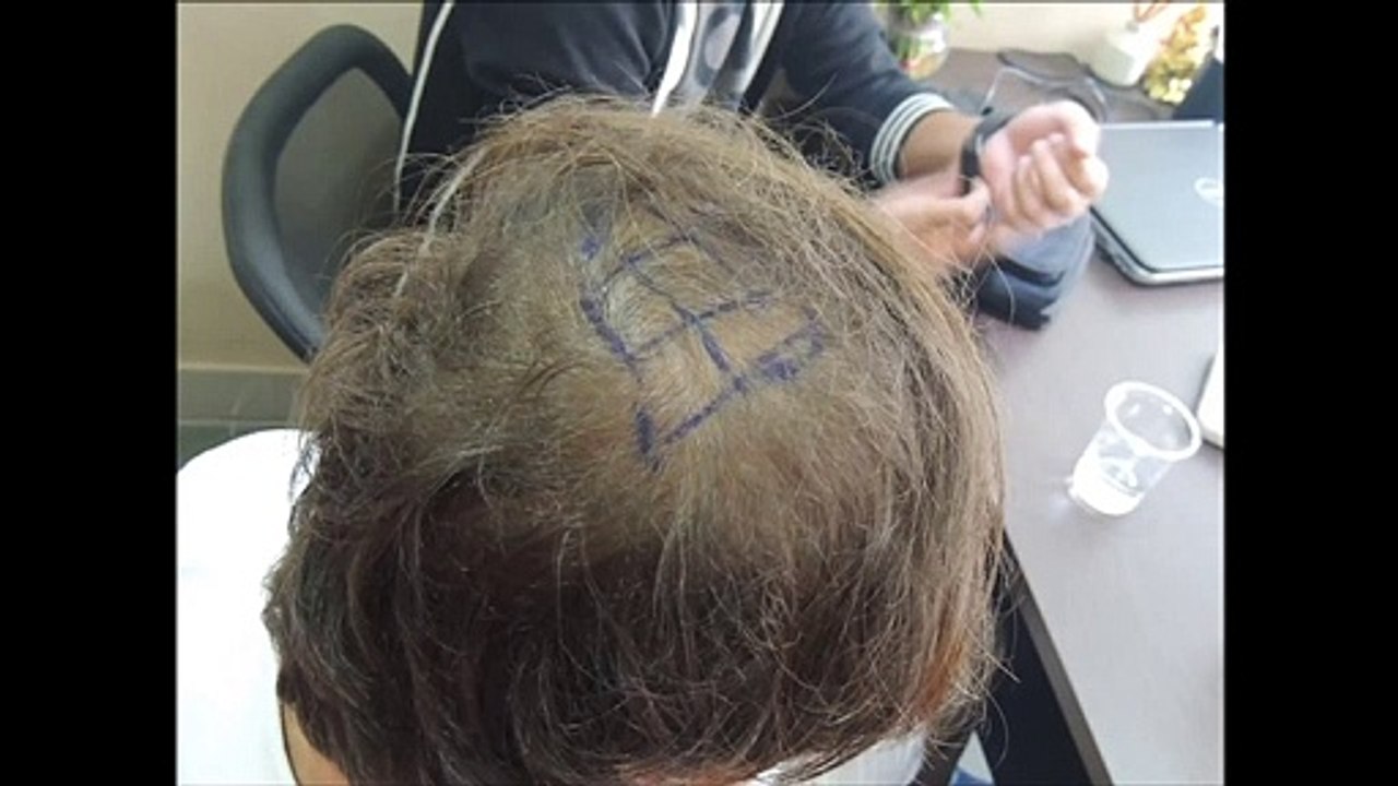 Hair Transplant in Pune by Dr. Amitabh Srivastava, Sai Cosmetics