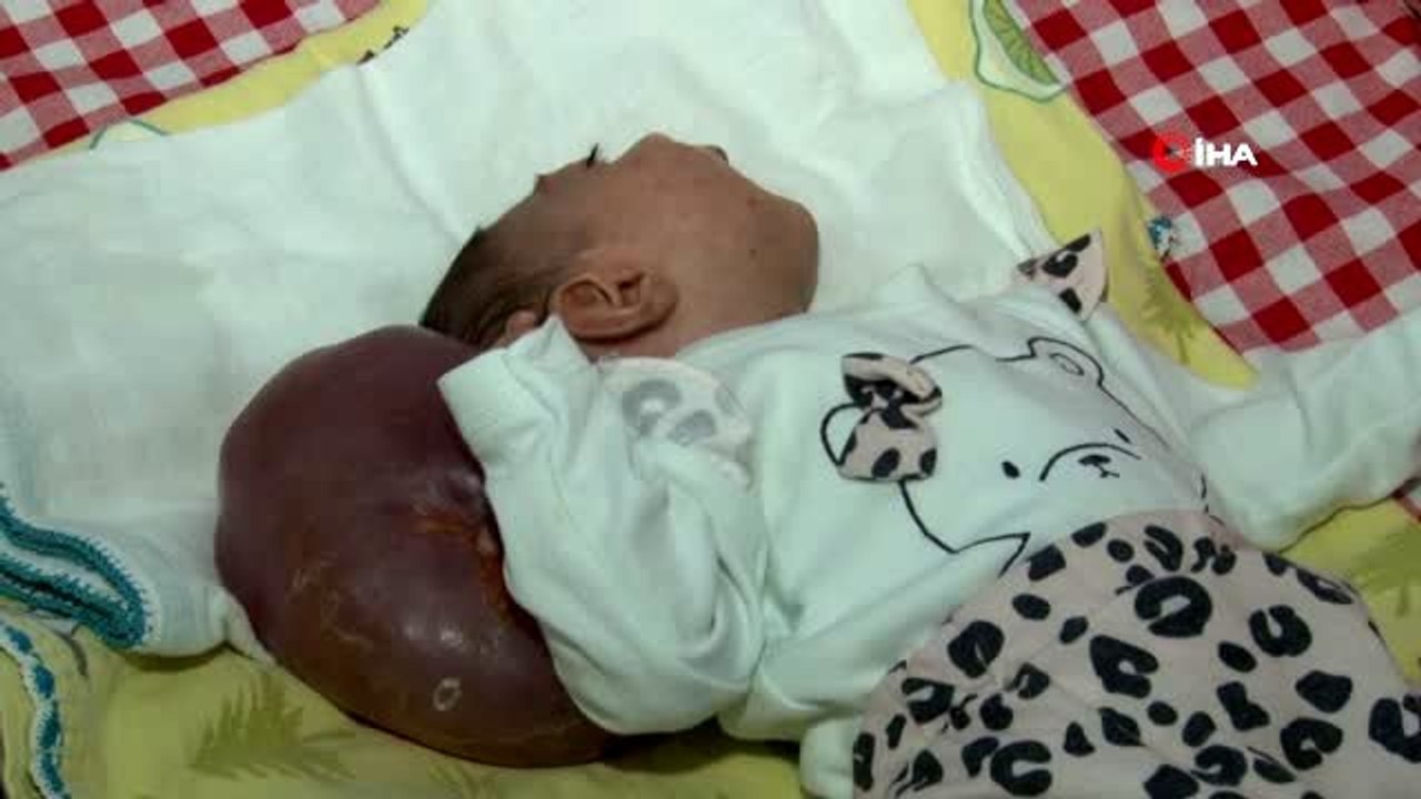 Doktorların "Ölür" dedikleri 2 kafalı doğan bebekleri için çare arıyorlar