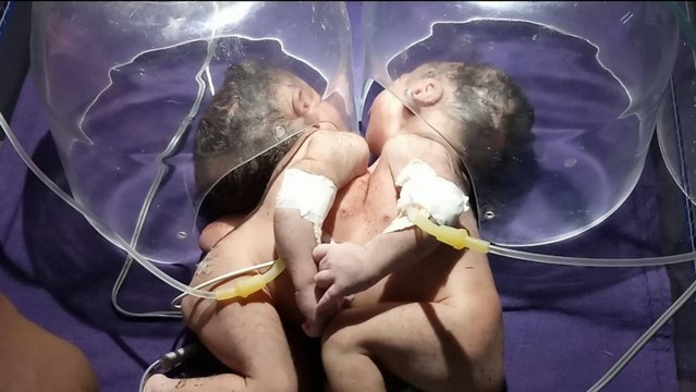بقلب واحد.. ولادة توأم ملتصق بحالة نادرة جدًا