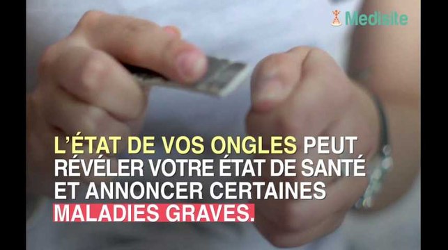 L'état de vos ongles peut révéler de graves maladies