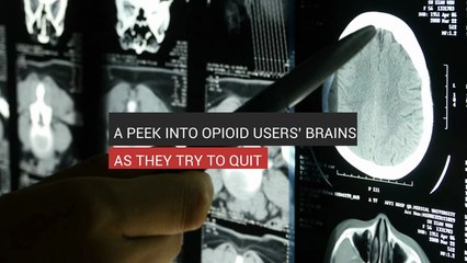 A Peek Into Opioid Users’ Brains As They Quit