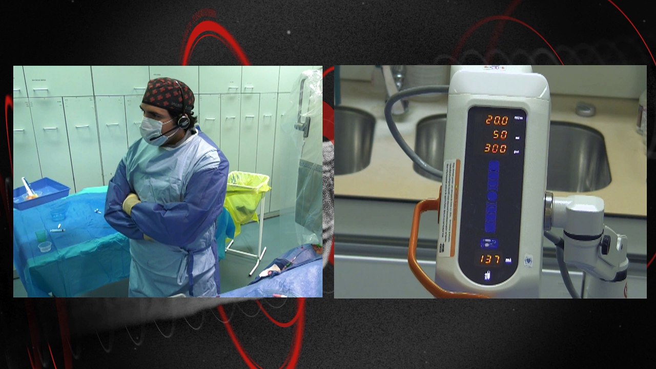 Microcirculation measurement: CFR derived by thermodilution and absolute coronary blood flow