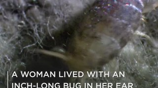 A Woman Lived With An Inch-Long Bug In Her Ear For An Entire Month
