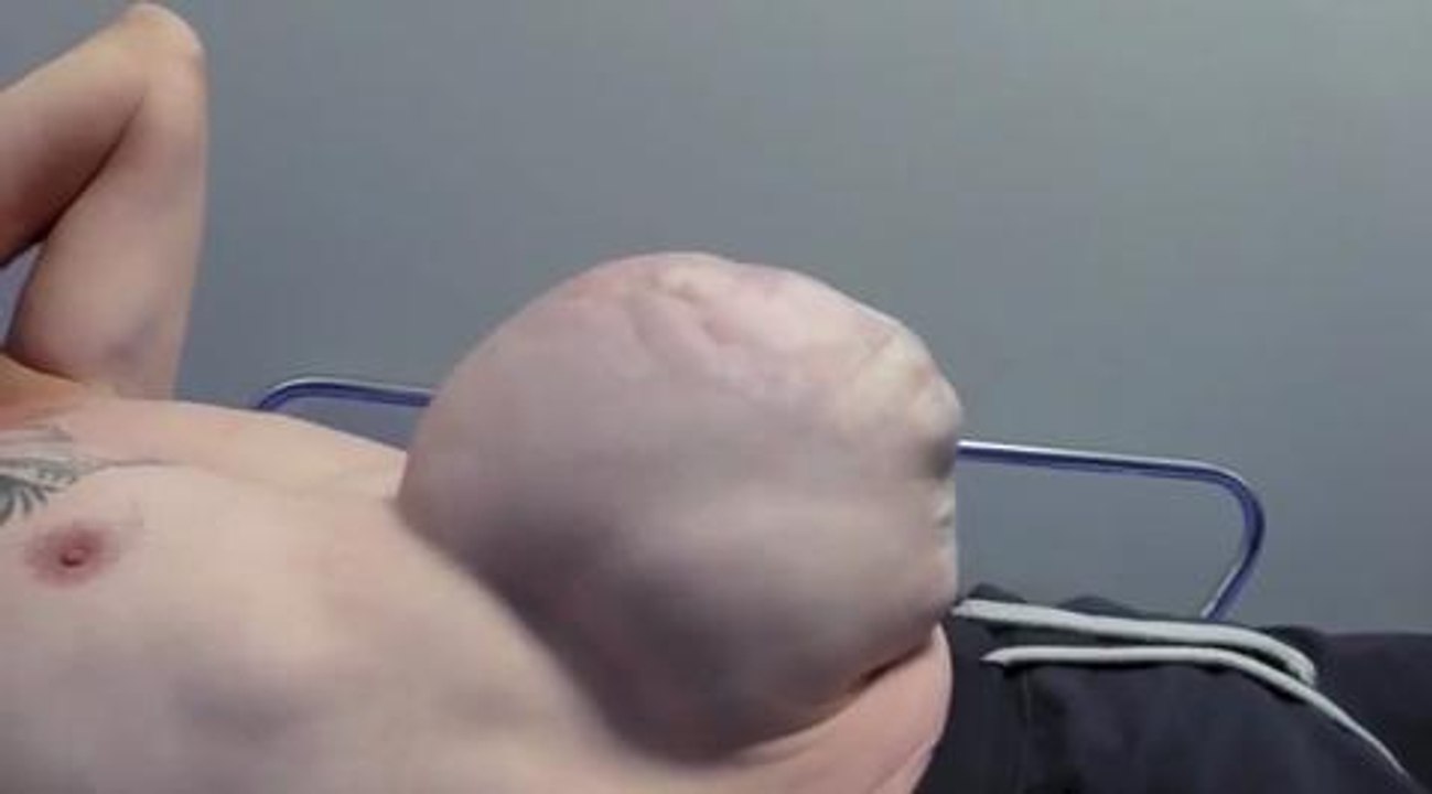 Surgeons fix giant hernia