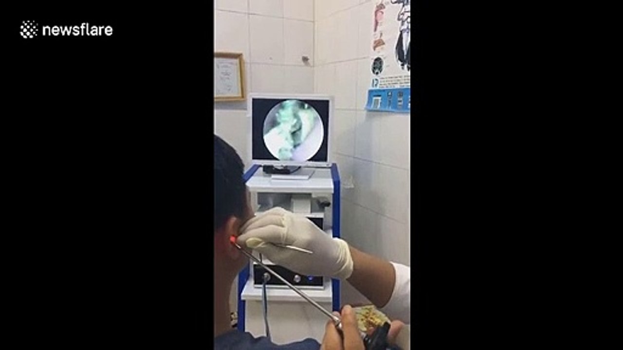 Ce médecin retire un papillon de l’oreille d’un patient