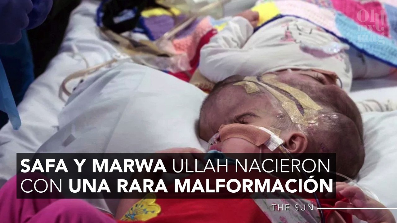 Gemelas siamesas son separadas después de más de 50 horas y 100 personas involucradas