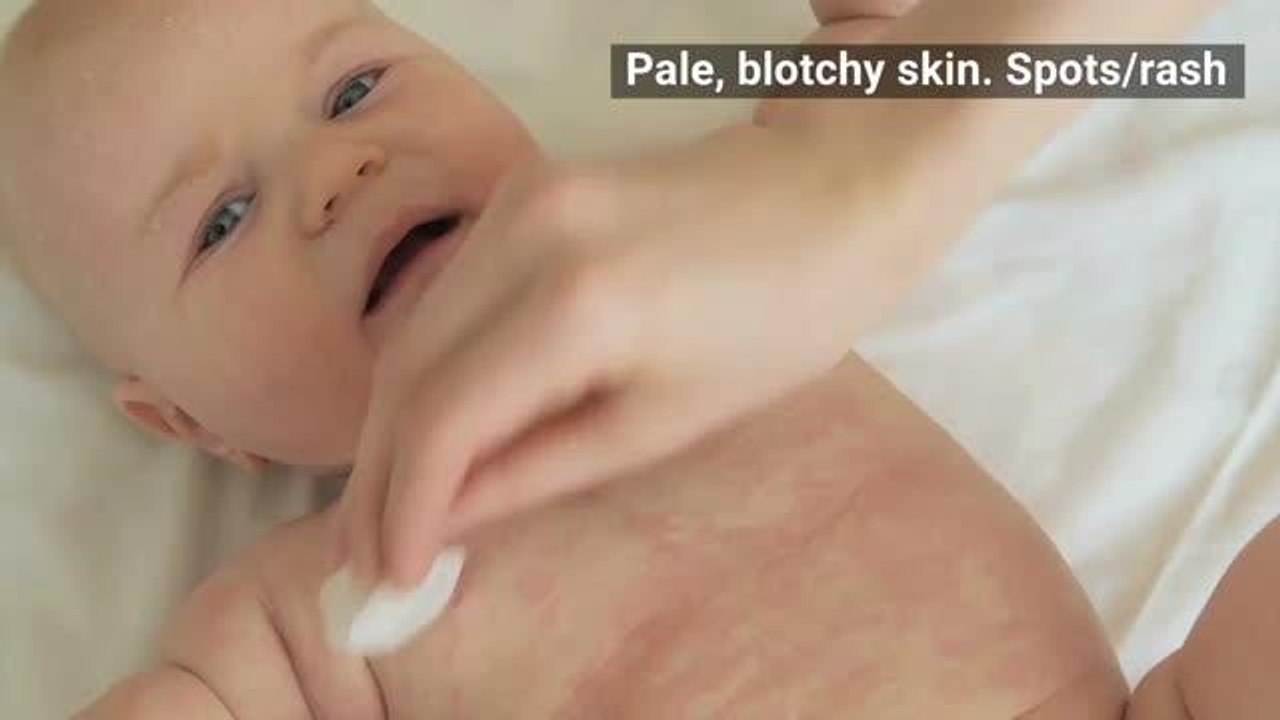 Meningitis