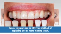 Dental Implants Are Best Option to Restore Missing Teeth - Dr. Brian Homann, DDS