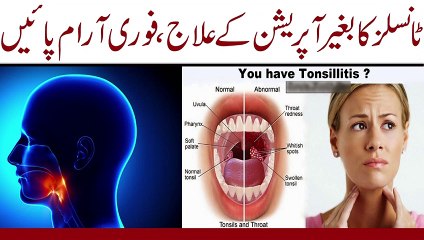 Tonsil infections ||  Gale ke tonsil ka zabardust ilaj || ٹانسلز کا شرطیہ علاج