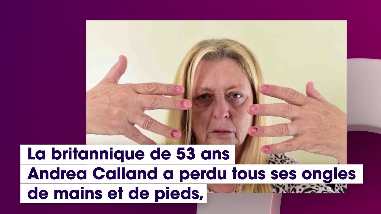 Cette jeune femme a perdu tous ses ongles à cause d’une étrange maladie