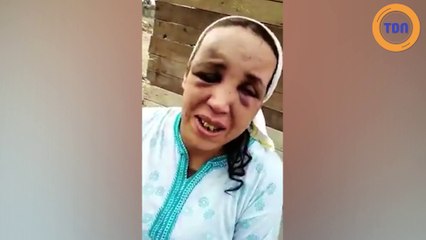 Victime de violences conjugales, cette marocaine dévoile ses blessures !