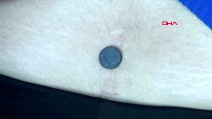 DENİZLİ BELİNDE 6 YIL ÖNCE UNUTULAN NEŞTER UCUNU MIKNATISLA BULDU-1