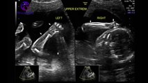 5 month pregnancy ultrasound  of Baby