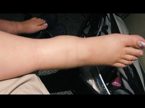 Wenn du wegen der Hitze geschwollene Füße hast, wird das hier dein Leben verändern!