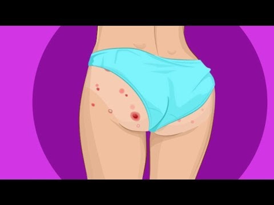 Po, Kinn oder Brust? Wo sich deine Pickel befinden, verrät mehr über deinen Körper als du denkst!