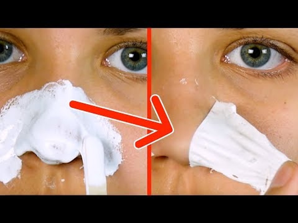 Ziehe hässliche Mitesser mit simplem Hausmittel einfach ab. Es funktioniert sofort!