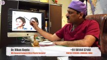 Explaining facial Fat Grafting Surgery by Dr. Vikas Gupta