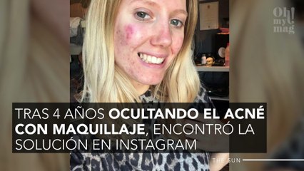 Sufrió acné quístico y lo curó con un remedio natural gracias a Instagram