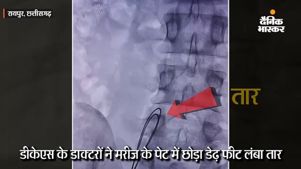 डीकेएस के डाक्टरों ने मरीज के पेट में छोड़ा डेढ़ फीट लंबा तार, दो माह बाद आधा निकाला, आधा लटक रहा बाहर