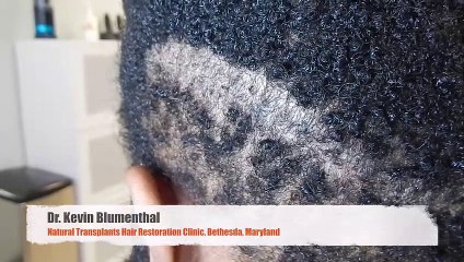 McLean VA Hair Transplant Clinic