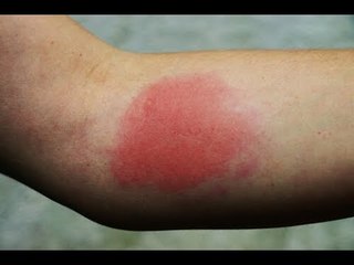 Report TV - Fier/ Shtohen pickimet nga merimanga dhe gjarpërinjtë, mjeku ngre alarmin