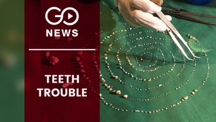 526 Teeth Removed From Boy's Mouth