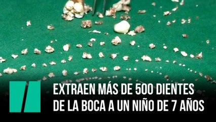 Extraen más de 500 dientes de la boca a un niño de 7 años