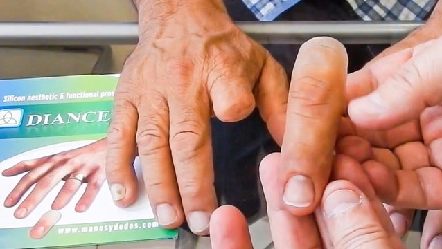 8 prostheses that are changing lives