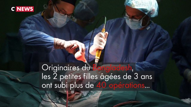 Après 30 heures d'opération, 2 fillettes siamoises reliées par la tête ont été séparées