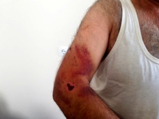 Engelli kız ve babası, muhtar adayına oy verdiği için sopalarla darp edildi