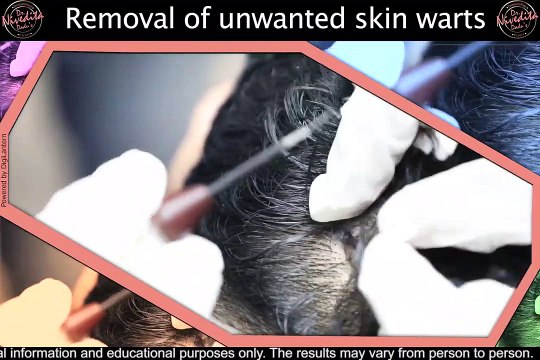 मस्से को जड़ से हटाने के उपाय | Warts Removal Treatment | Dr. Nivedita Dadu
