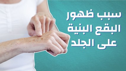 سبب ظهور البقع البنية على الجلد