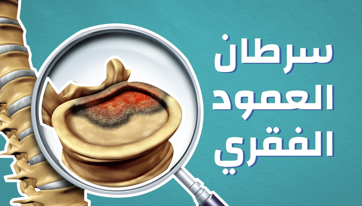 سرطان العمود الفقري