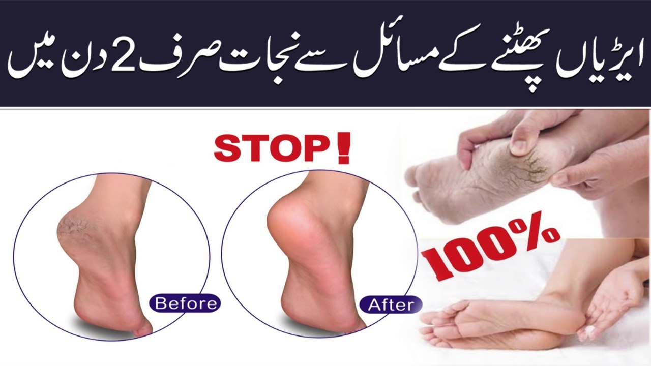 Cracked Heels Home Remedy || Cracked Heels Treatment || پھٹی ایڑیوں کا آسان علاج