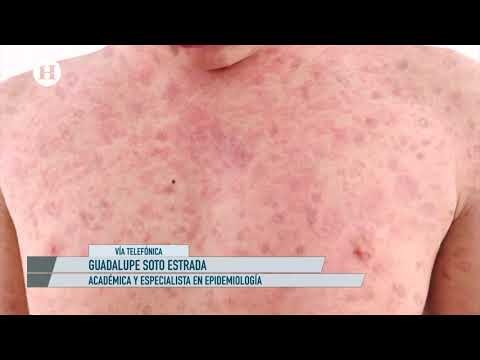Brote de sarampión podría darse por desabasto de vacunas, asegura epidemióloga