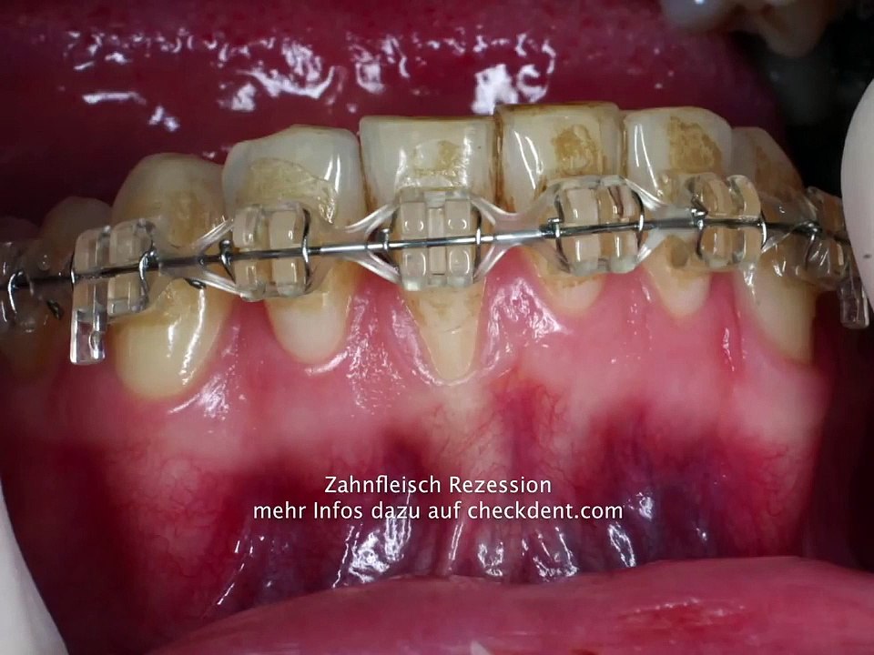 Brennen im Mund - oder wann brennt es im Mund?