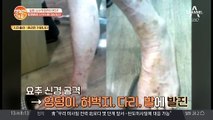 출산보다 고통스러운 '대상포진'! 사실 합병증이 더 무섭다?! (ㅠㅠ)