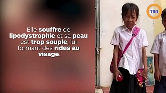 Une écolière de 10 ans ressemble à une femme de 60 ans et subit les moqueries au quotidien !