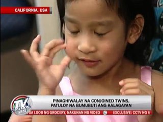 Once conjoined twins continue to recover