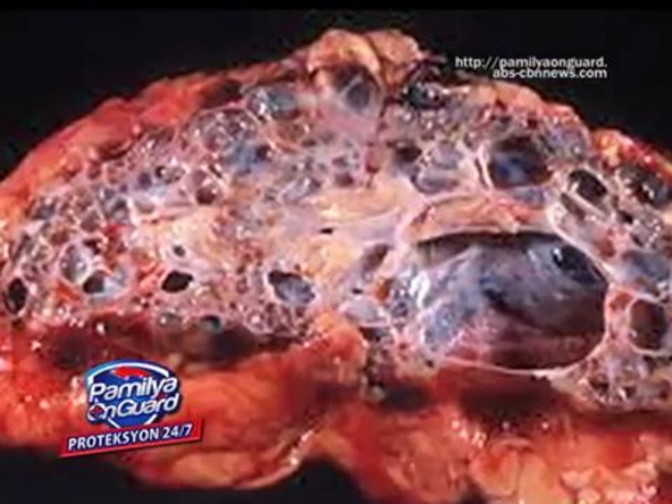 pamilyaonguard-LEPTOSPIROSIS BACTERIA CAN ENTER THE BODY EVEN WITHOUT OPEN WOUNDS- EXPERTS